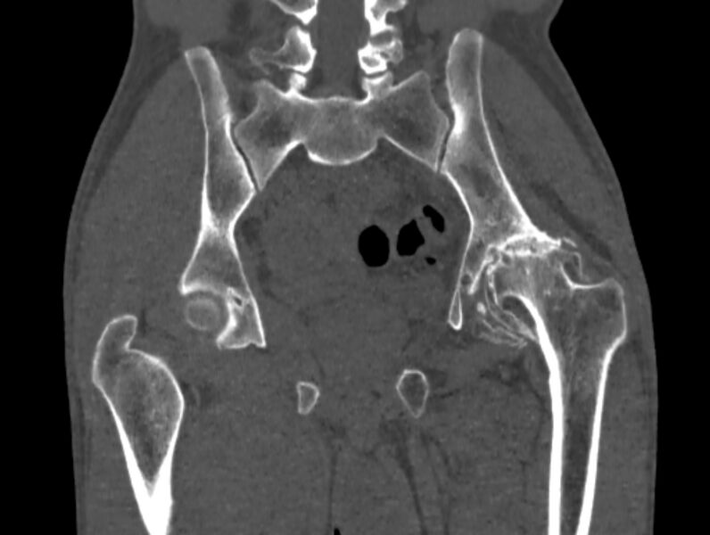 File:Avascular necrosis of the left hip (Radiopaedia 75068-86125 Coronal bone window 48).jpg
