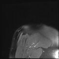 Avulsion fracture - greater tuberosity of humerus (Radiopaedia 71216-81515 Coronal PD fat sat 1).jpg