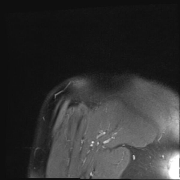 File:Avulsion fracture - greater tuberosity of humerus (Radiopaedia 71216-81515 Coronal PD fat sat 1).jpg