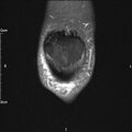 Avulsion fracture of the fibular head (Radiopaedia 74804-85808 Coronal PD fat sat 6).jpg