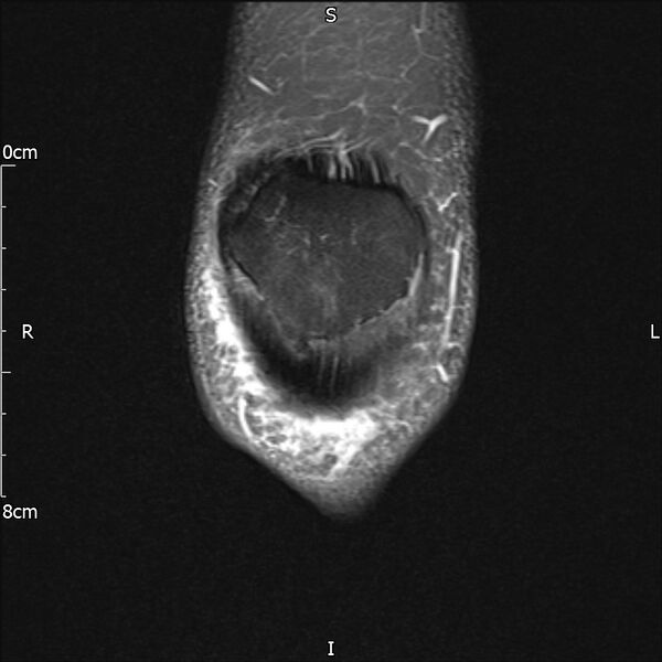 File:Avulsion fracture of the fibular head (Radiopaedia 74804-85808 Coronal PD fat sat 6).jpg