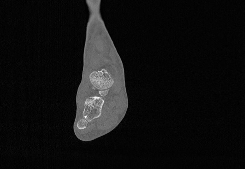 Avulsion fractures of talus and calcaneus (Radiopaedia 48277-53155 Coronal bone window 42).jpg