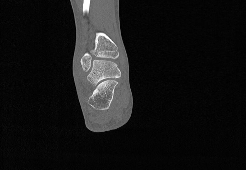 File:Avulsion fractures of talus and calcaneus (Radiopaedia 48277-53155 Coronal bone window 73).jpg