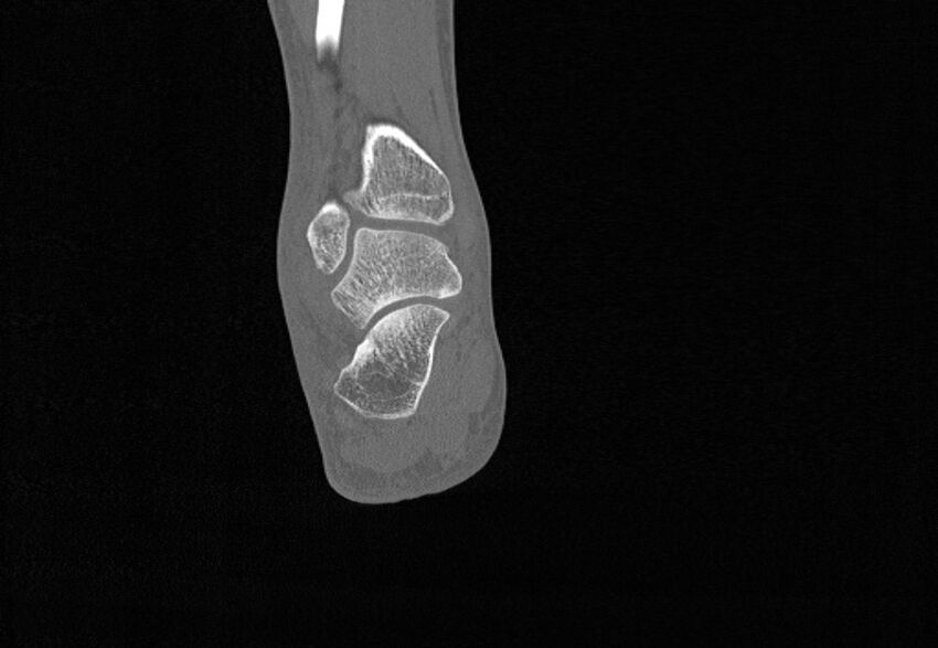 Avulsion fractures of talus and calcaneus (Radiopaedia 48277-53155 Coronal bone window 73).jpg