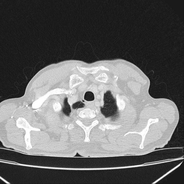 File:Azygos lobe (Radiopaedia 38259-40275 Axial lung window 6).jpg