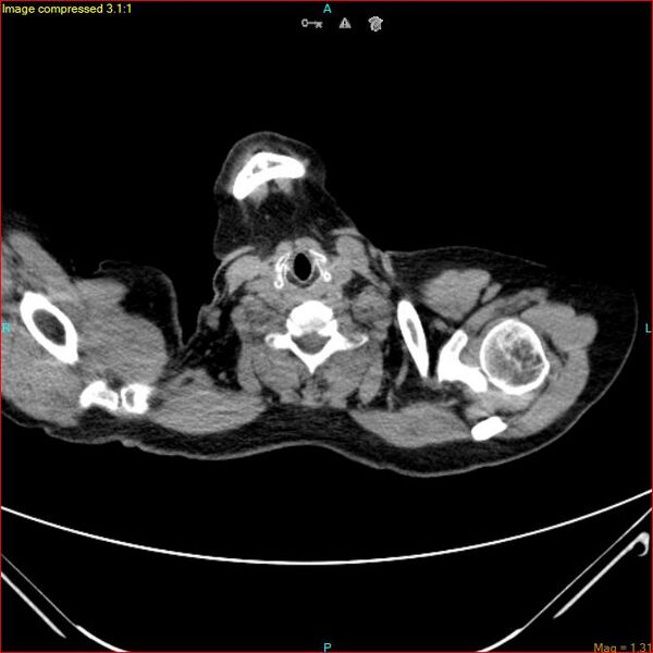 File:Azygos vein aneurysm (Radiopaedia 77824-90130 A 2).jpg