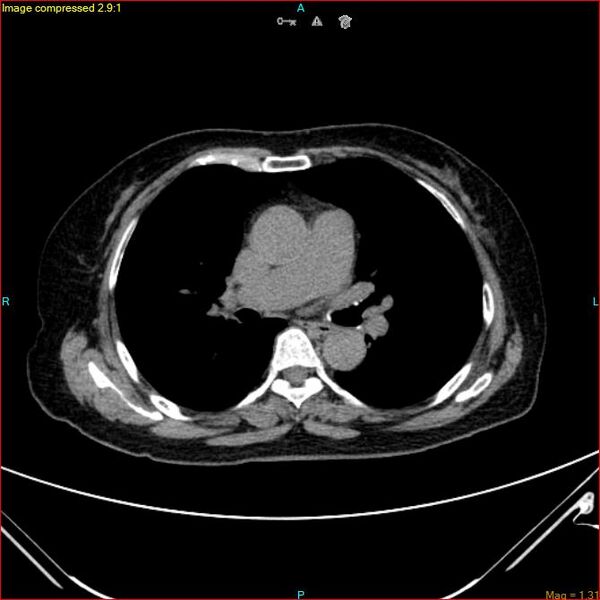 File:Azygos vein aneurysm (Radiopaedia 77824-90130 A 30).jpg