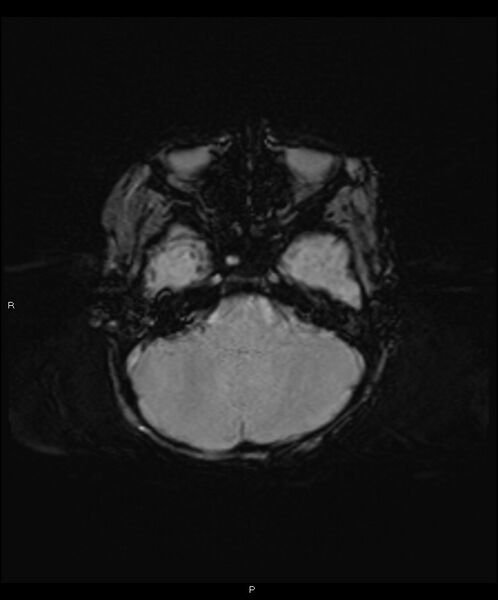 File:Basal ganglia and parenchymal ischemia (Radiopaedia 45818-50084 Axial SWI 10).jpg