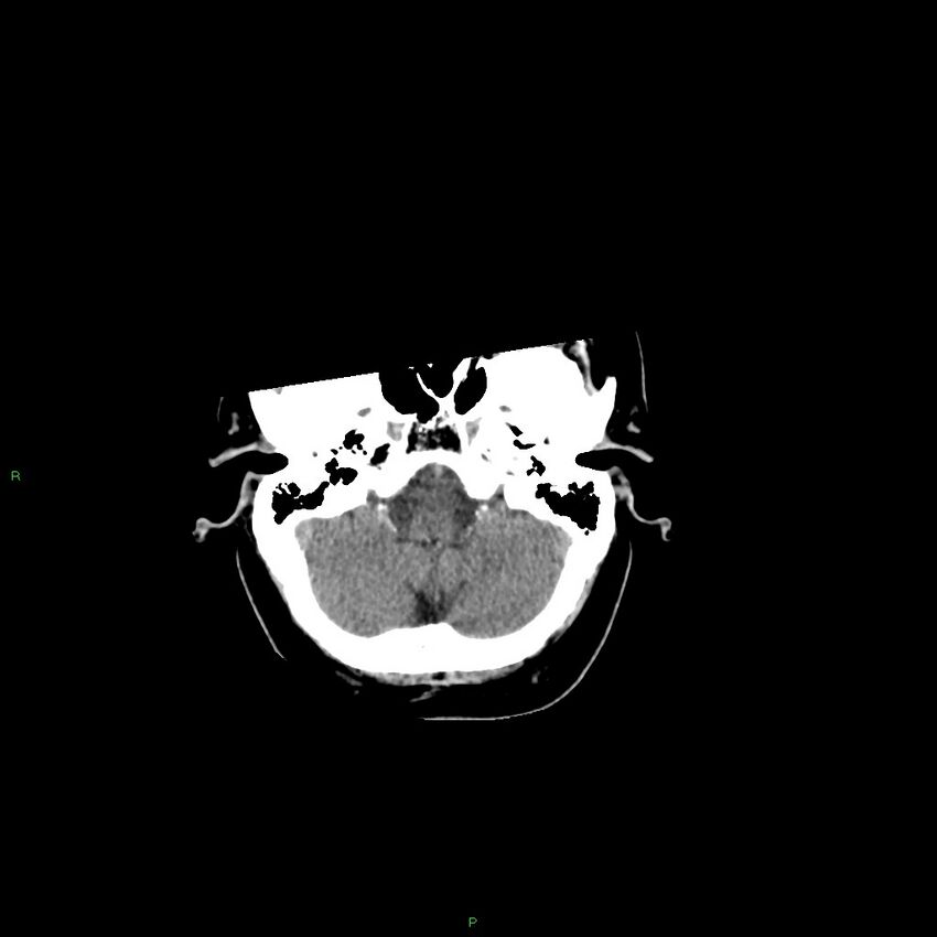 Basal ganglia hemorrhage (Radiopaedia 58346-65467 Axial non-contrast 47).jpg