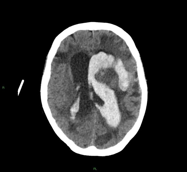 File:Basal ganglia hemorrhage (Radiopaedia 58766-65988 Axial non-contrast 28).jpg