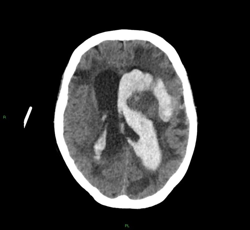 Basal ganglia hemorrhage (Radiopaedia 58766-65988 Axial non-contrast 28).jpg