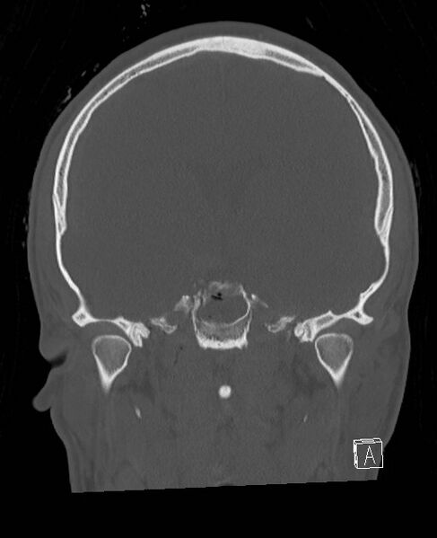 File:Base of skull fracture with bilateral Le Fort fractures (Radiopaedia 47094-51638 Coronal bone window 50).jpg