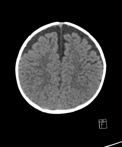 File:Benign enlargement of subarachnoid spaces in infancy (BESS) (Radiopaedia 87459-103795 Axial non-contrast 26).jpg