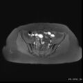 Bicornuate uterus- on MRI (Radiopaedia 49206-54297 Axial T1 fat sat 6).jpg