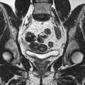 Bicornuate uterus (Radiopaedia 11104-11492 Coronal T2 12).jpg