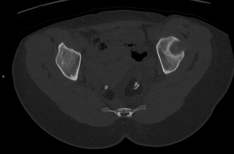 File:Bilateral mature cystic ovarian teratoma (Radiopaedia 88821-105592 Axial bone window 29).jpg
