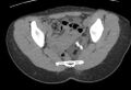 Bilateral mature cystic ovarian teratoma (Radiopaedia 88821-105592 Axial non-contrast 21).jpg