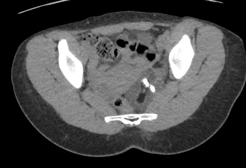 File:Bilateral mature cystic ovarian teratoma (Radiopaedia 88821-105592 Axial non-contrast 21).jpg