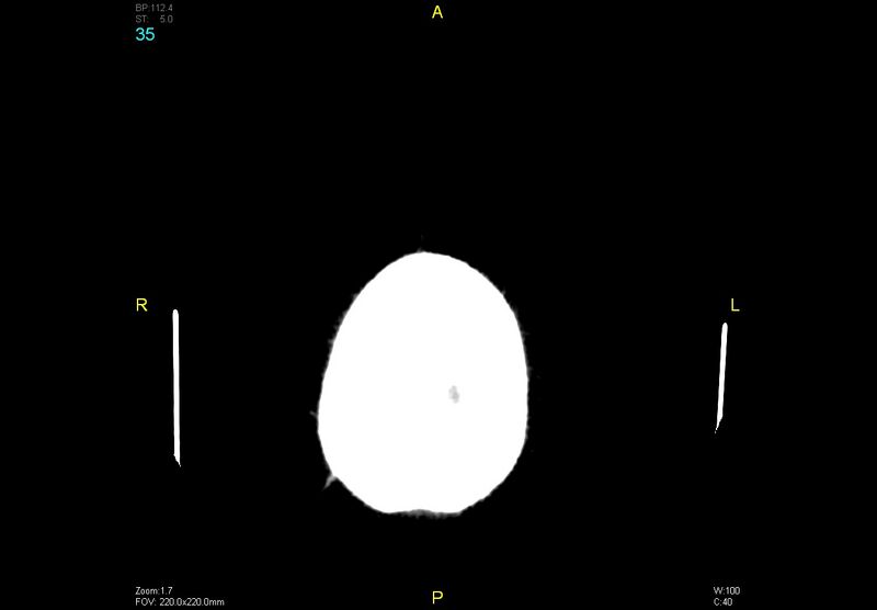 File:Bilateral medial medullary infarction (Radiopaedia 42220-45295 Axial non-contrast 35).jpg