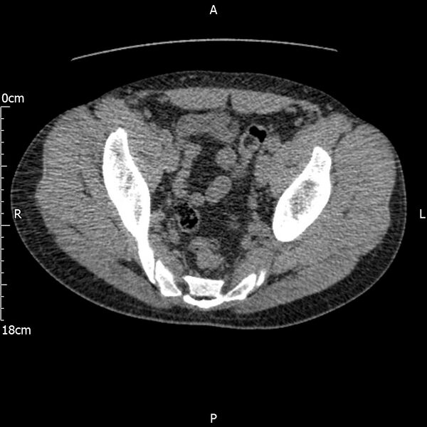 File:Bilateral medullary nephrocalcinosis with ureteric calculi (Radiopaedia 71269-81569 Axial non-contrast 112).jpg