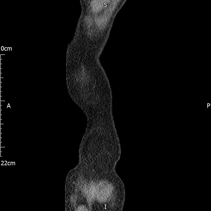 Bilateral medullary nephrocalcinosis with ureteric calculi (Radiopaedia 71269-81569 C 111).jpg