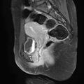 Bilateral ovarian endometriomas (Radiopaedia 87085-103347 F 14).jpg