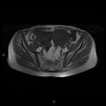 Bilateral ovarian fibroma (Radiopaedia 44568-48293 Axial T1 9).jpg
