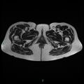 Bilateral ovarian fibroma (Radiopaedia 44568-48293 Axial T2 32).jpg