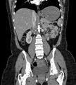Bilateral ovarian mature cystic teratomas (Radiopaedia 79373-92457 B 43).jpg