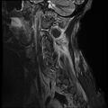 Bilateral perched facets with cord injury (Radiopaedia 45587-49714 Sagittal STIR 16).jpg