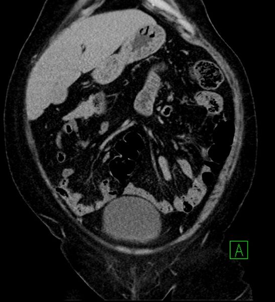 File:Bilateral sporadic synchronous clear cell renal cell carcinoma (Radiopaedia 85035-100575 I 5).jpg