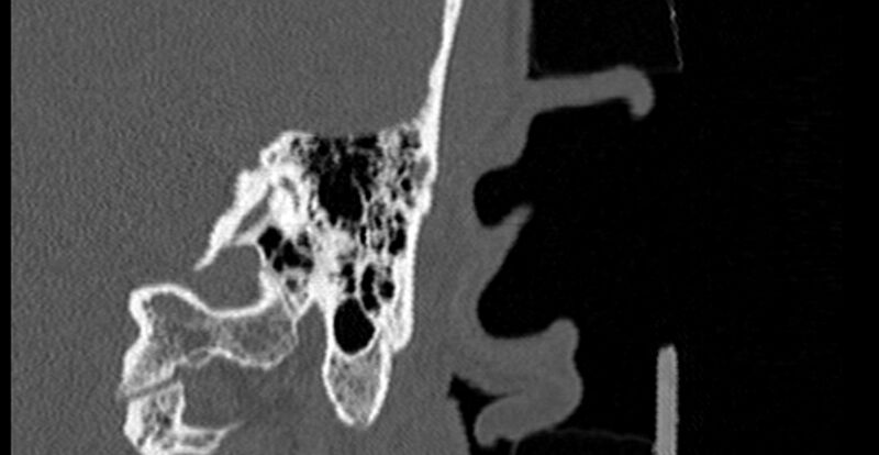 File:Bilateral temporal bone fractures (Radiopaedia 29482-29970 B 68).jpg