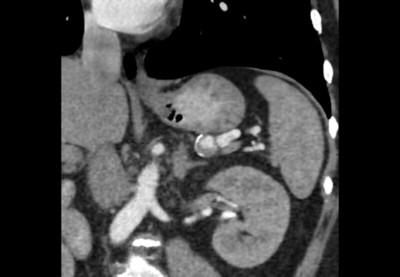 File:Bilateral urolithiasis with incidentally detected splenic artery aneurysm and left inferior vena cava (Radiopaedia 44467-48127 Ob. Cor. C+ Art. 14).jpg