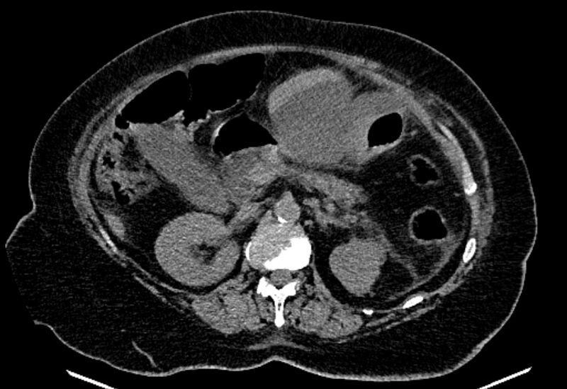 File:Biliary pancreatitis (Radiopaedia 72289-82823 Axial non-contrast 103).jpg