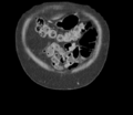 Bladder papillary urothelial carcinoma (Radiopaedia 48119-52951 C 9).png
