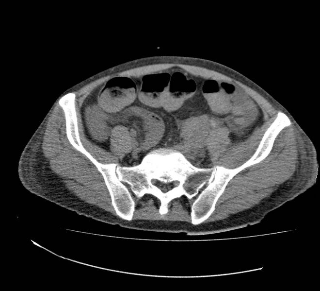 File:Bowel lymphoma complicated by bleeding after therapy (Radiopaedia 55601-62110 Axial non-contrast 62).jpg
