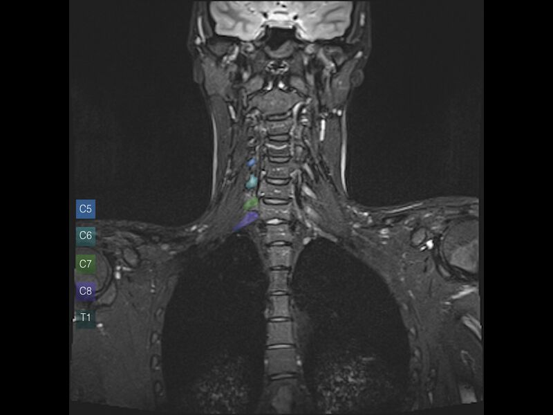 File:Brachial plexus anatomy (Radiopaedia 64414-73226 Coronal STIR 5).jpeg