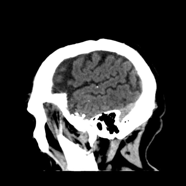 File:Brain Pantopaque remnants (Radiopaedia 78403-91048 C 47).jpg