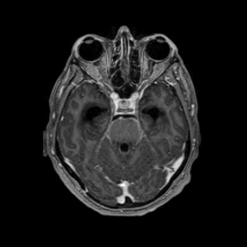 Brain abscess complicated by intraventricular rupture and ventriculitis (Radiopaedia 82434-96577 Axial T1 C+ 20).jpg
