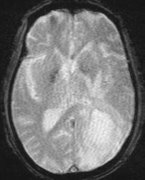 File:Brain abscess with dual rim sign (Radiopaedia 87566-103938 Axial SWI 12).jpg