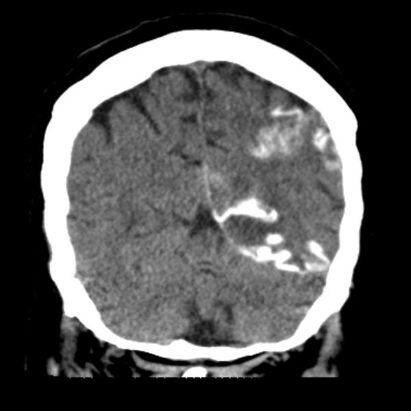 File:Brain cortical laminar necrosis (Radiopaedia 25822-25971 C 42).jpg