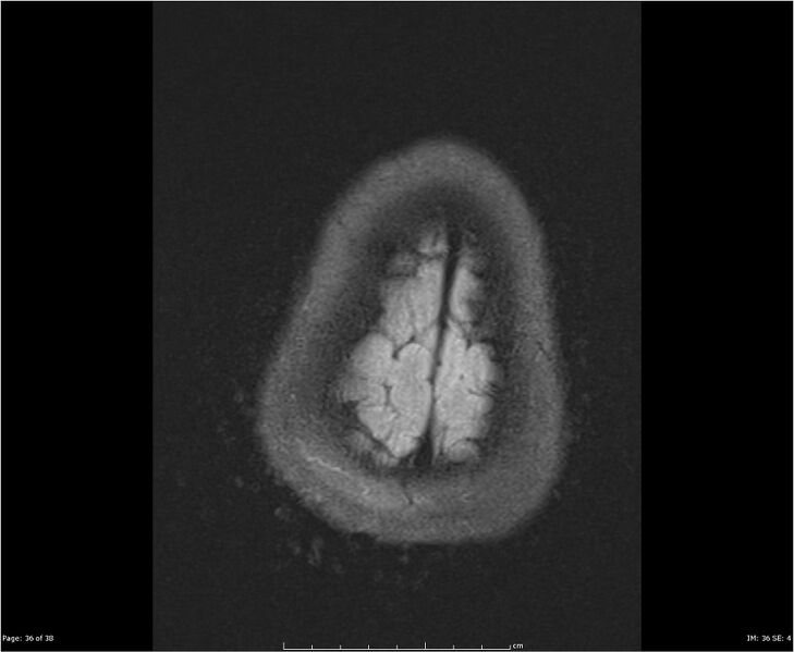 File:Brainstem glioma (Radiopaedia 21819-21775 Axial FLAIR 36).jpg