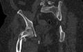 Breast carcinoma with pathological hip fracture (Radiopaedia 60314-67993 Coronal bone window 75).jpg