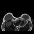 Breast implants - MRI (Radiopaedia 26864-27035 Axial T1 15).jpg