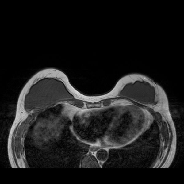 File:Breast implants - MRI (Radiopaedia 26864-27035 Axial T1 15).jpg