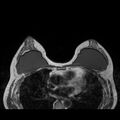 Breast implants - MRI (Radiopaedia 26864-27035 Axial T1 28).jpg