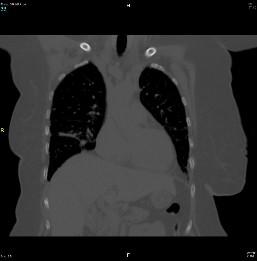 Breast primary with lung and bone metastases (Radiopaedia 40620-43228 bone window 33).jpg
