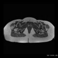 Broad ligament fibroid (Radiopaedia 49135-54241 Axial T1 15).jpg