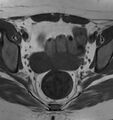 Broad ligament leiomyoma (Radiopaedia 81634-95516 Axial T1 14).jpg
