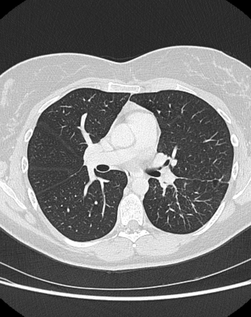 Bronchial atresia (Radiopaedia 50007-55297 Axial lung window 48).jpg